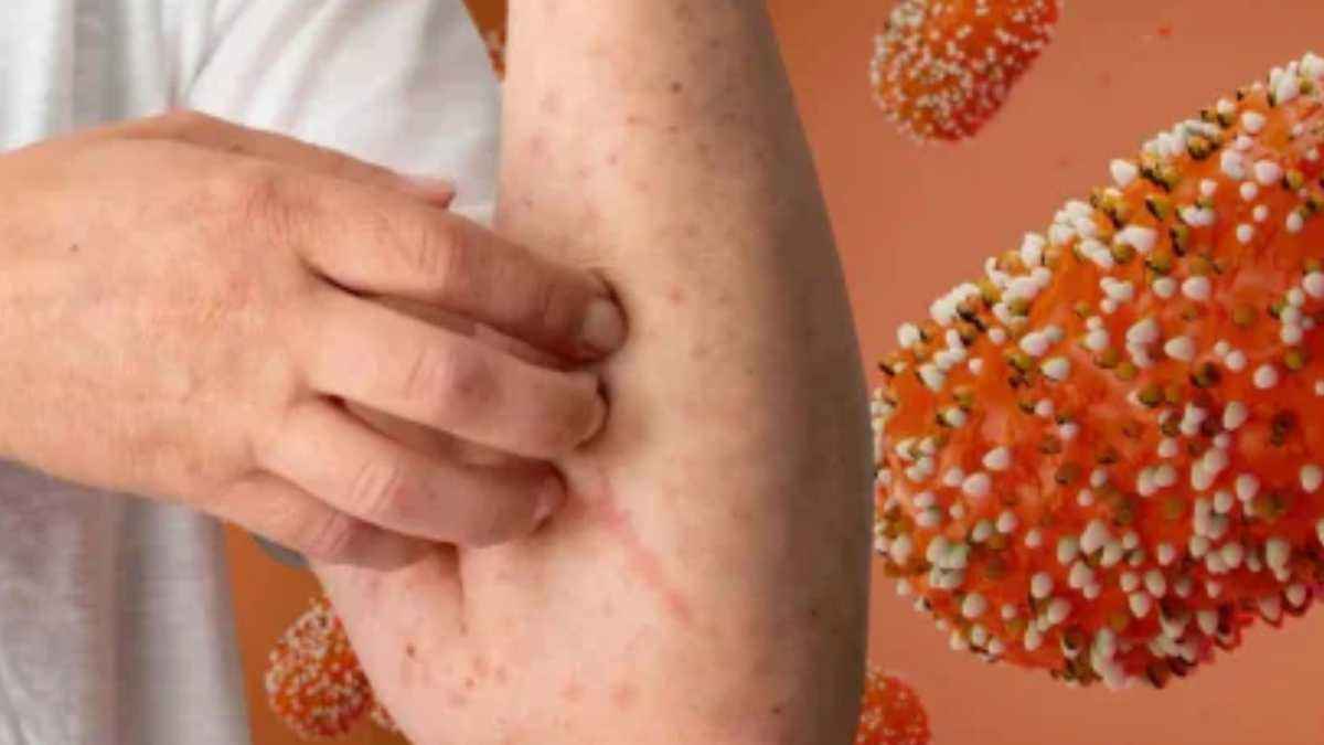 Alarm in kolumbien: neue monkeypox-variante ib aufgetaucht!