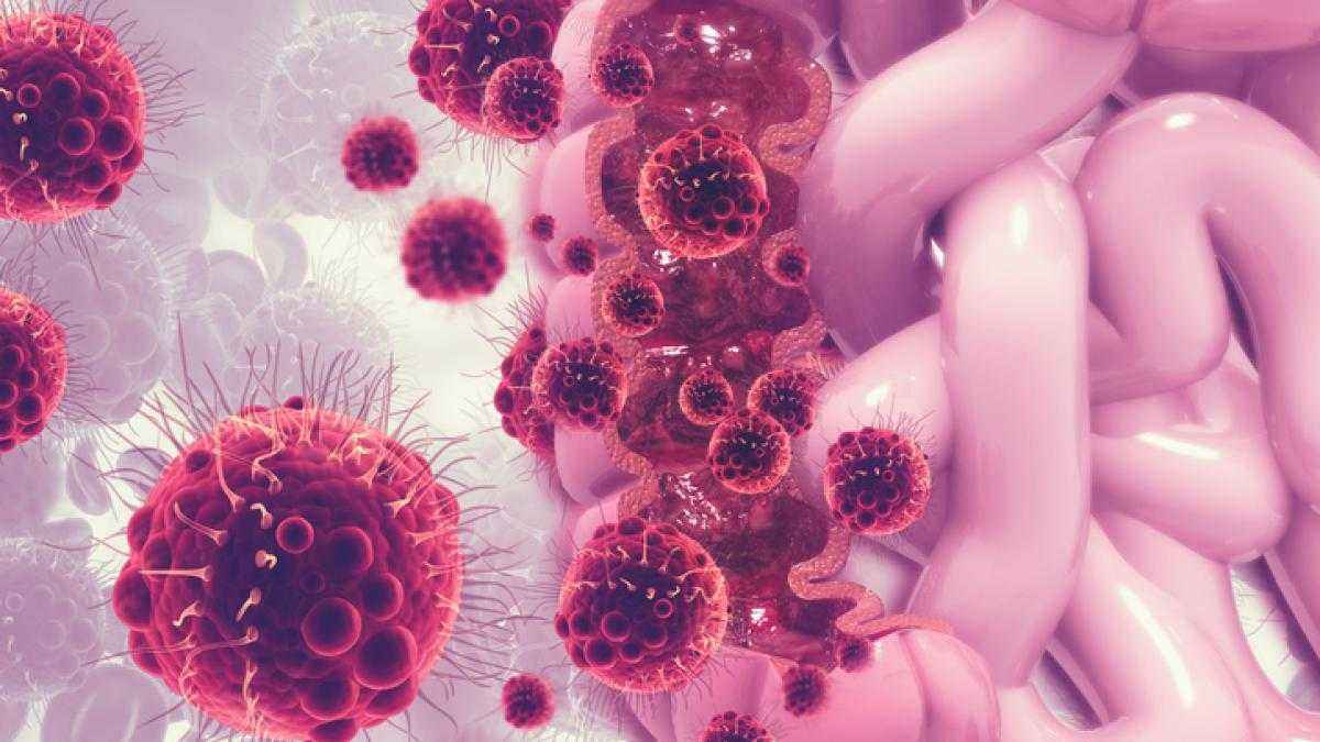 Darmstadt-studie: virus im darm könnte darmkrebs begünstigen