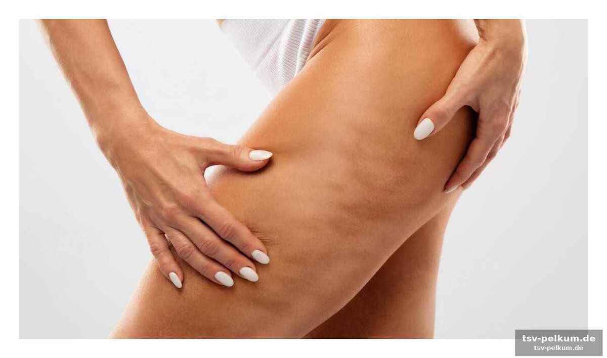 Die drei stärksten verbündeten im kampf gegen cellulitis