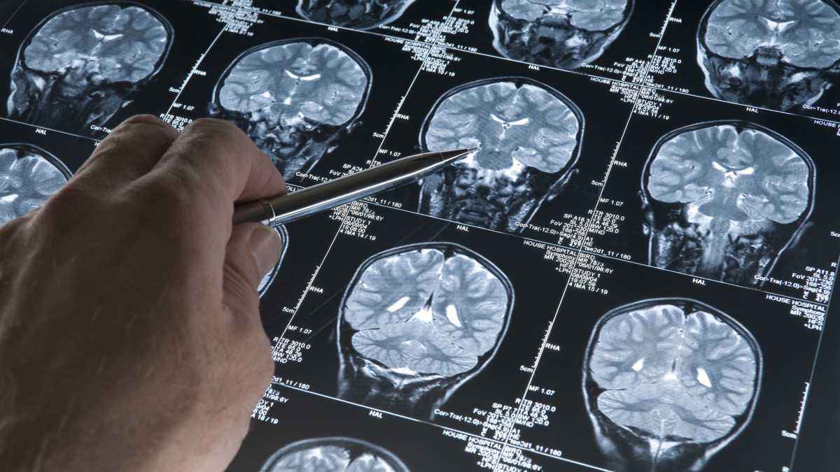 Gehirn spielt verrückt: tumor als ursache für psychische krise?