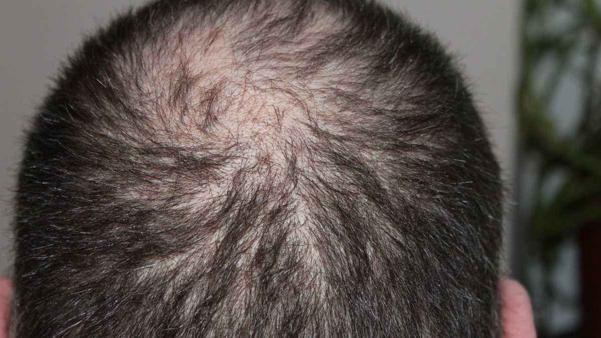 Kahlheitstop nach 27 jahren stagnation: neue us-wirkstoffe lassen haare wieder wachsen