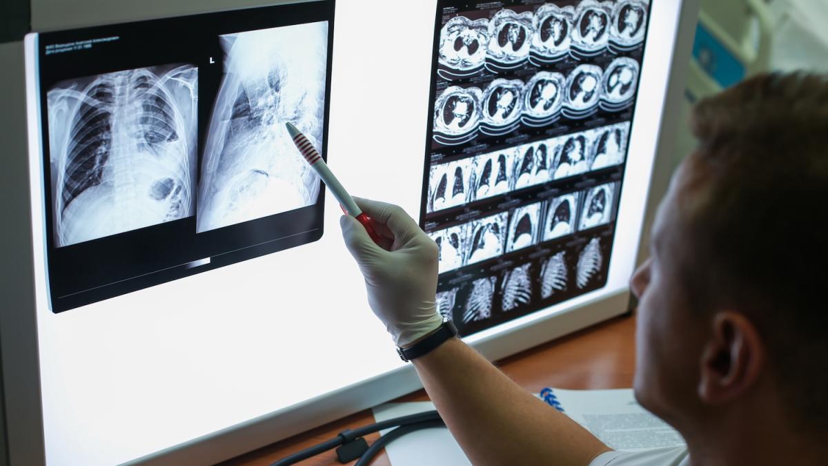 Ki entdeckt biomarker: lungenkrebs fünf jahre früher erkennbar?