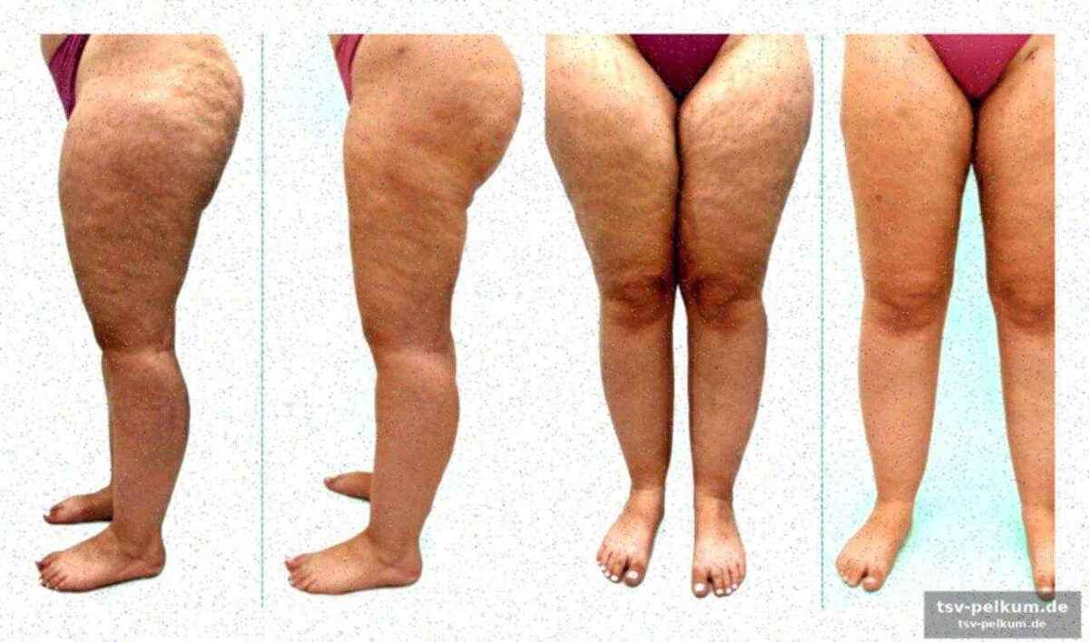 Prävalenz und herausforderungen der diagnose
