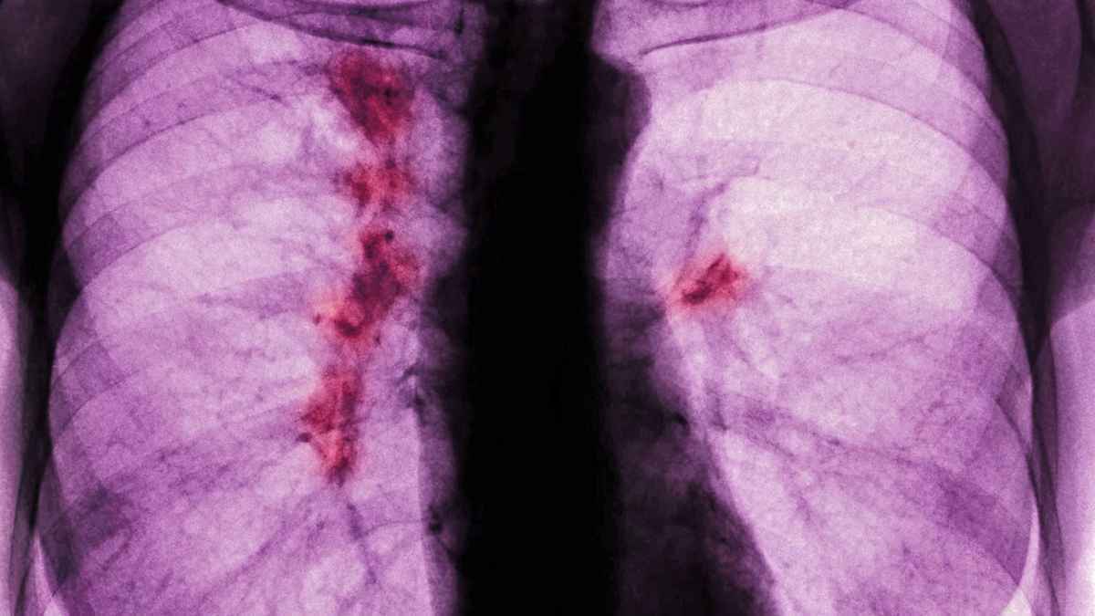 Lungenkrebs bei jungen: gesunde ernährung könnte überraschungsfaktor sein
