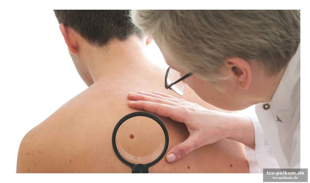 Wo melanome lauern – und warum man hinsieht