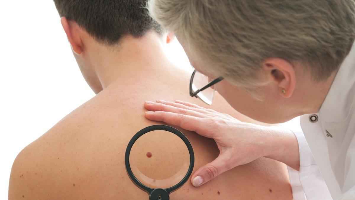 Melanom-erkennung: italienisches diagnostikzentrum warnt vor falschen sicherheit