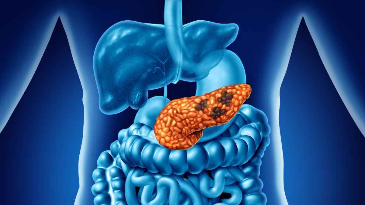 Pancreaticus-durchbruch gefährdet: interessenkonflikt wirft schatten!
