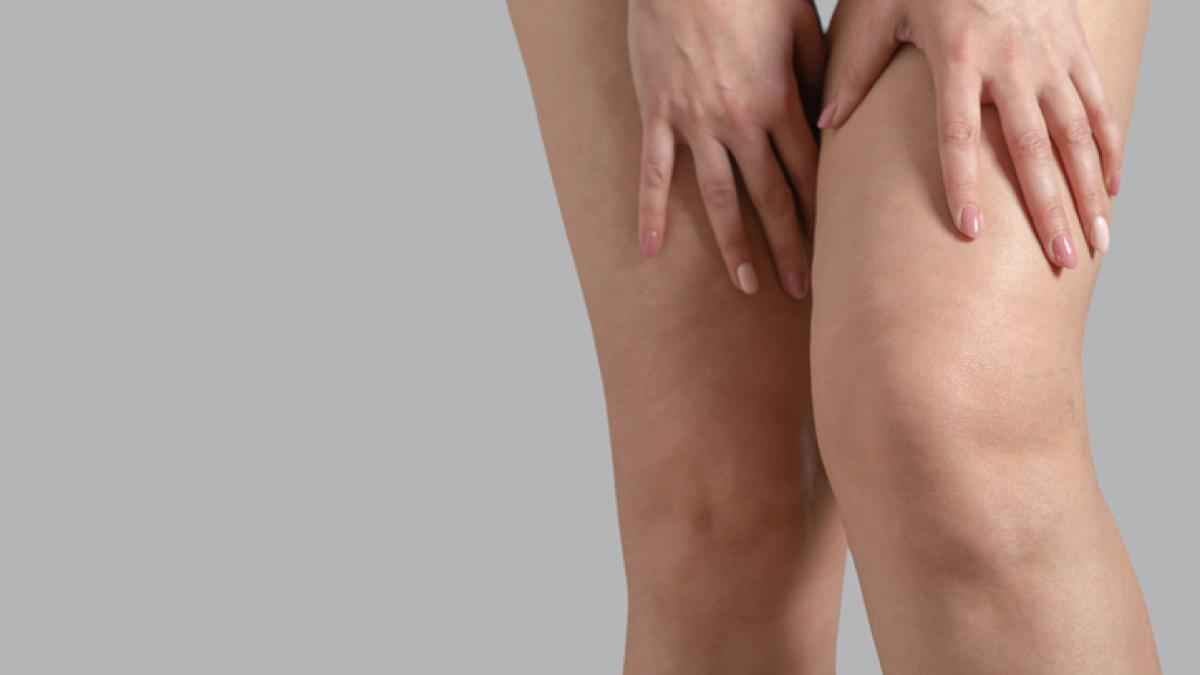 Schwellende beine: lymphödem oder lipödem? die verwechslungsgefahr!